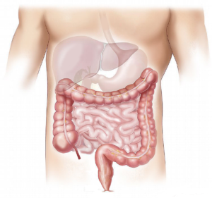 gastro-osofageale reflux